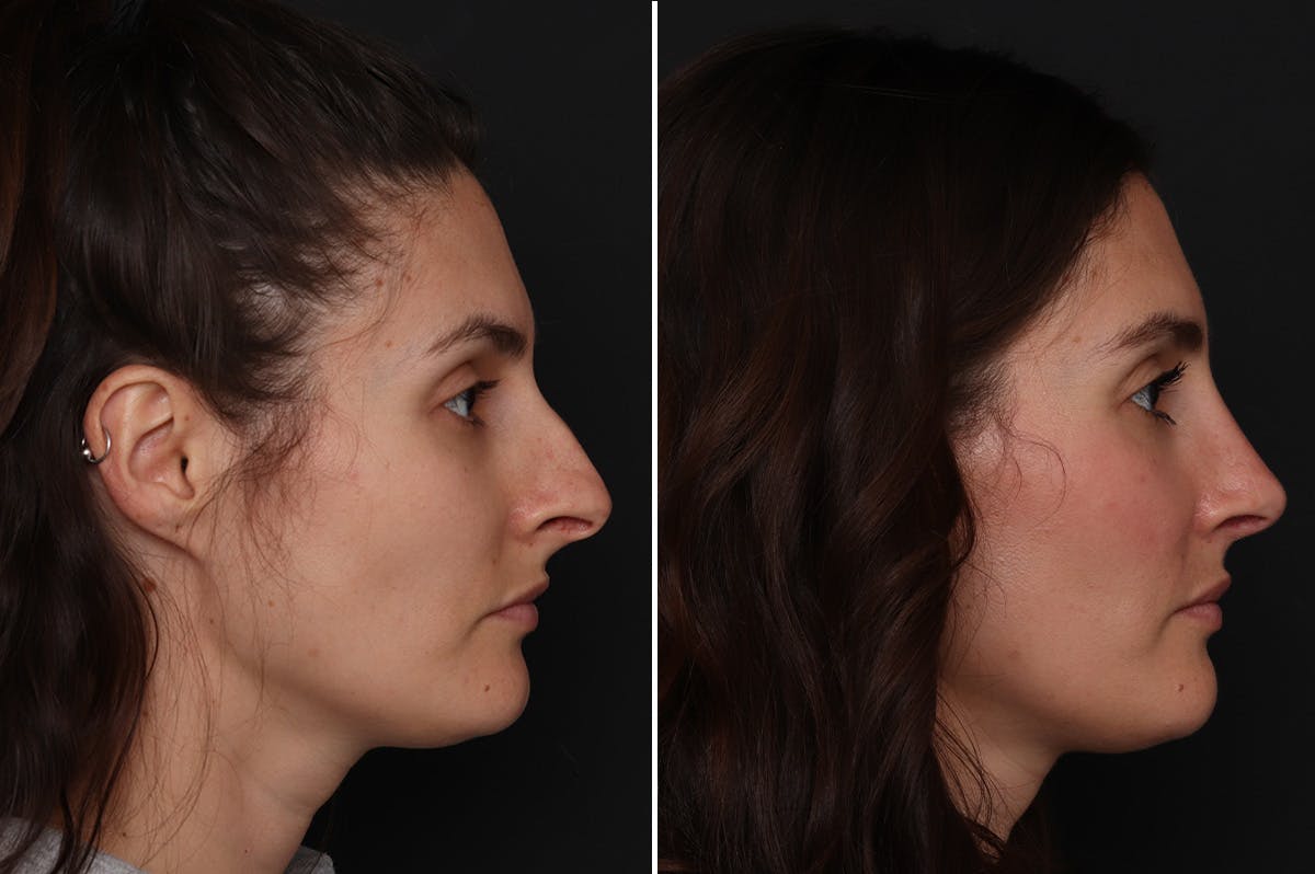 Rhinoplasty Before & After Gallery - Patient 111886 - Image 2