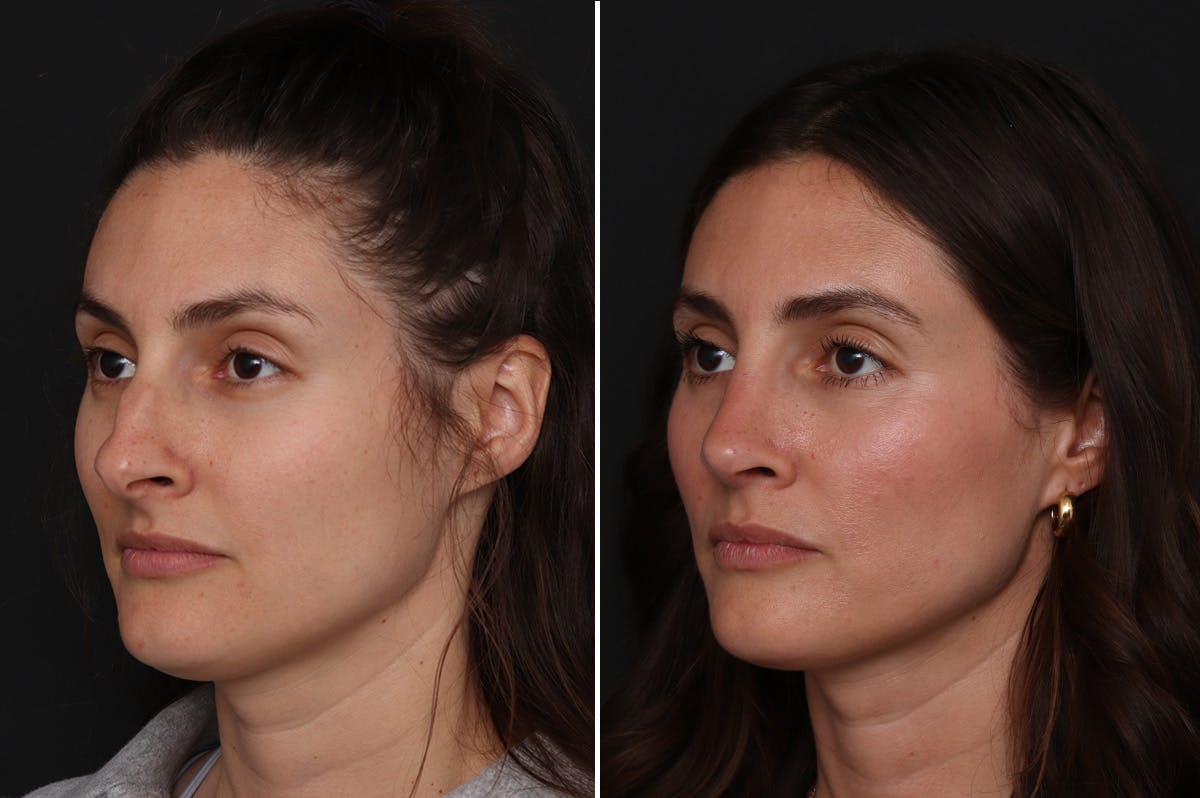 Rhinoplasty Before & After Gallery - Patient 111886 - Image 3