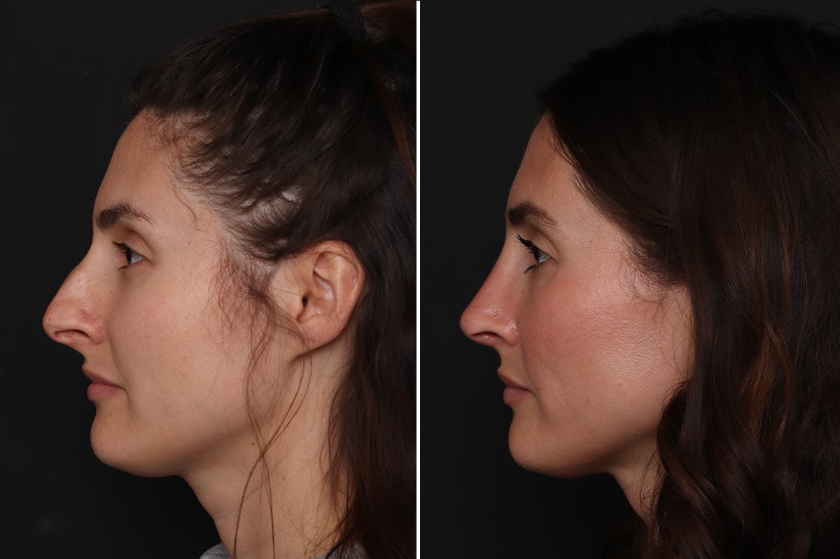 Rhinoplasty Before & After Gallery - Patient 111886 - Image 4