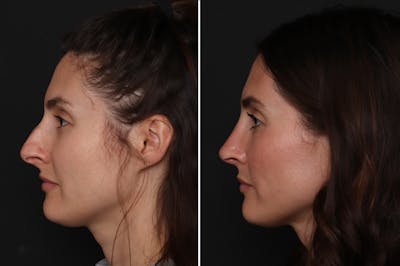 Rhinoplasty Before & After Gallery - Patient 111886 - Image 1