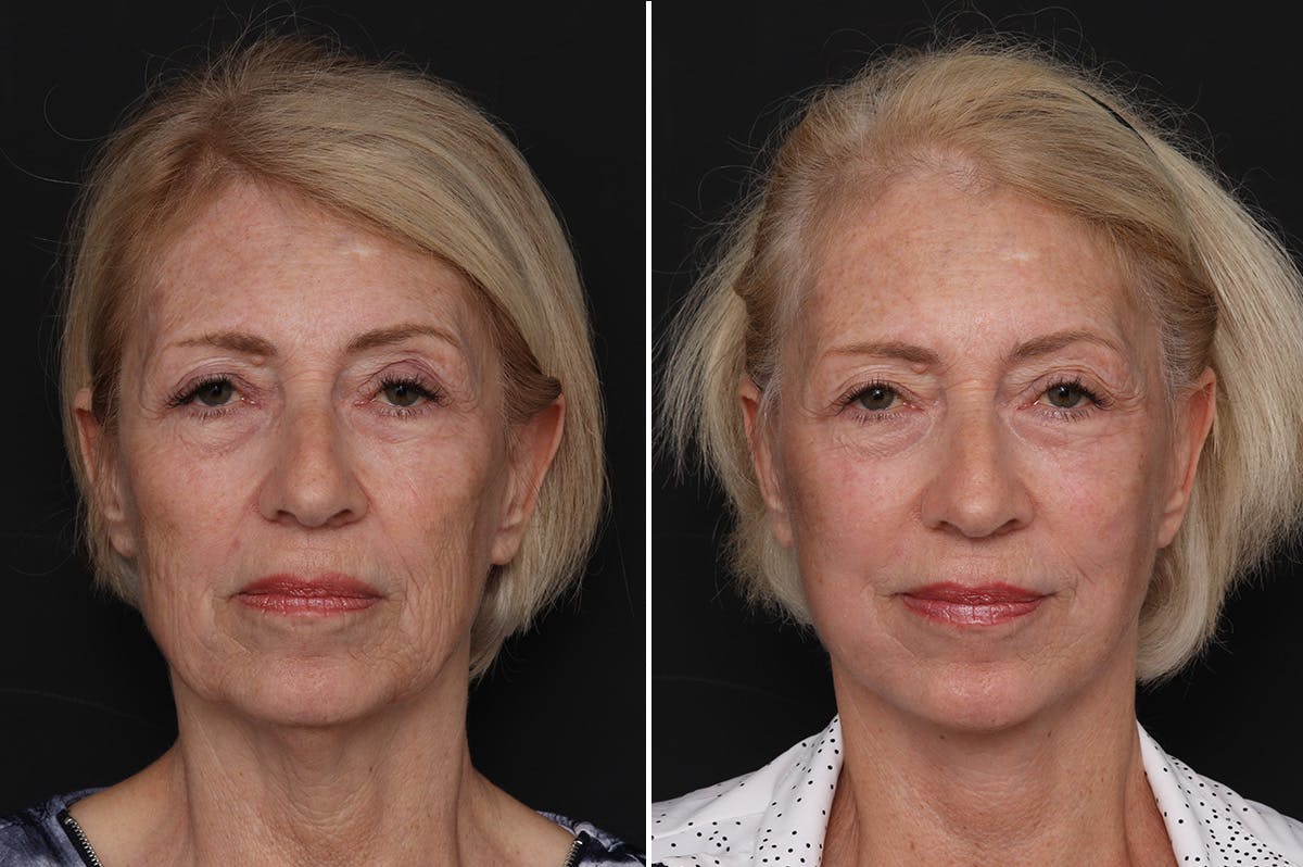 Facelift Before & After Gallery - Patient 228938 - Image 3