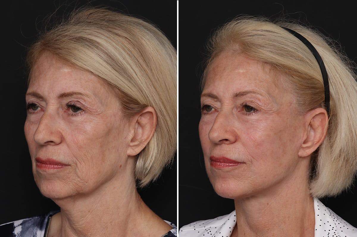 Facelift Before & After Gallery - Patient 228938 - Image 2