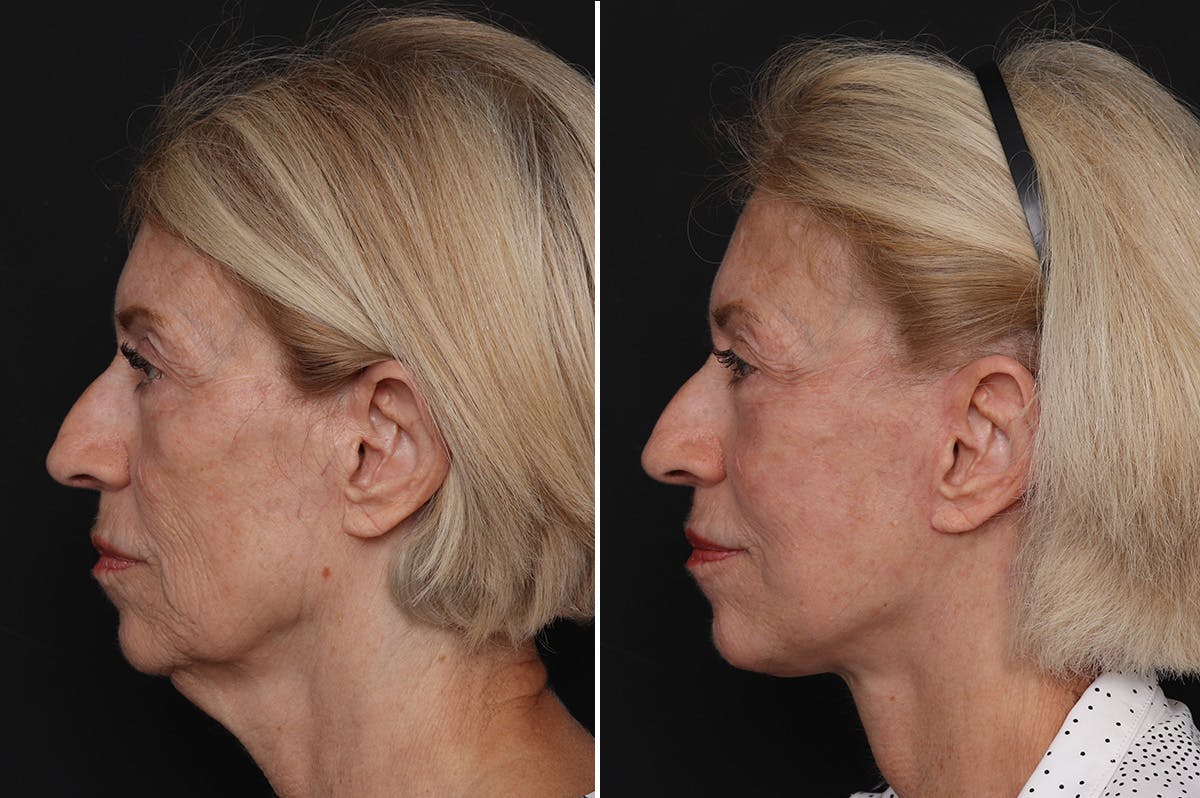 Facelift Before & After Gallery - Patient 228938 - Image 1