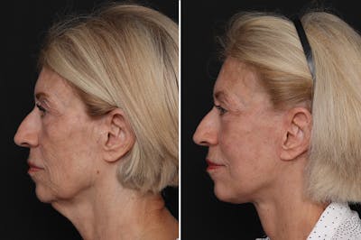 Facelift Before & After Gallery - Patient 228938 - Image 1