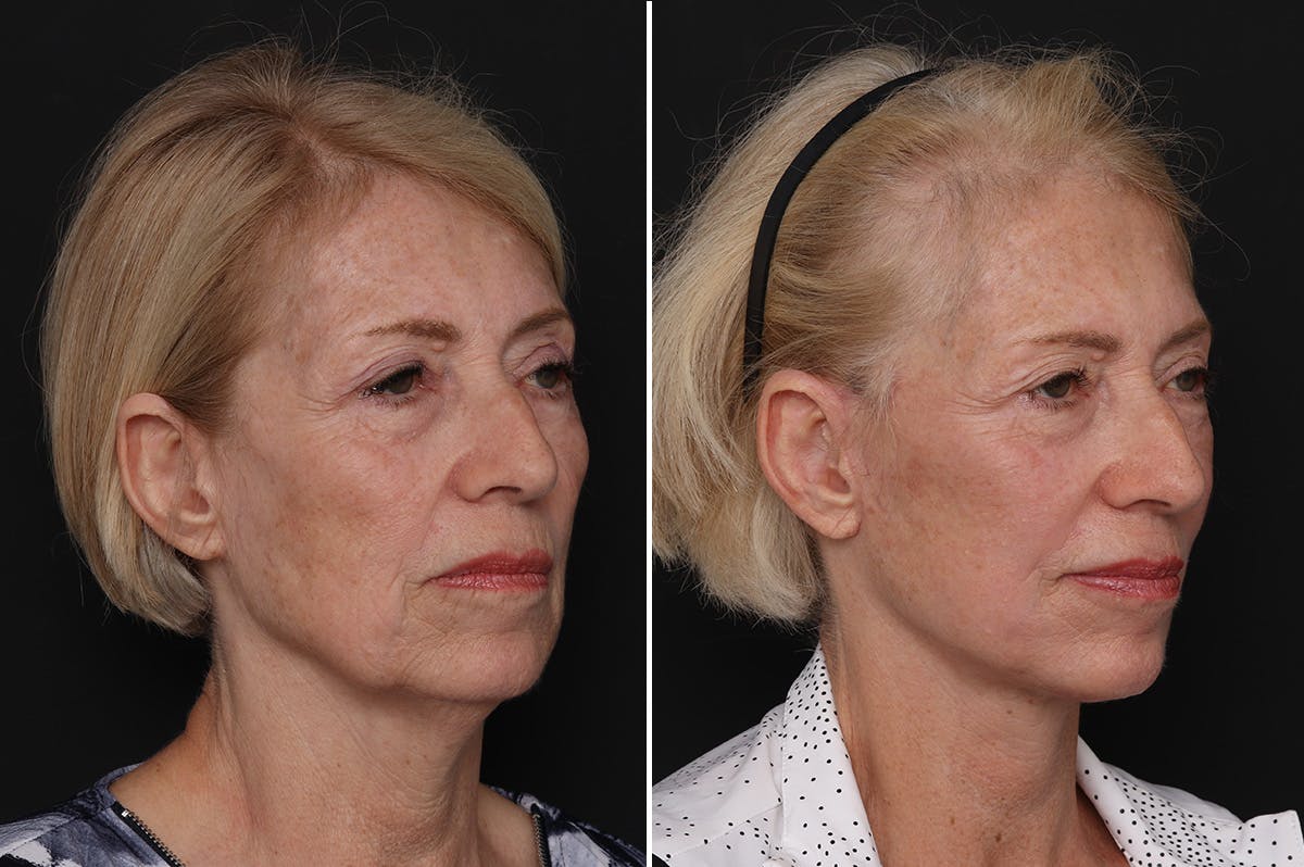Facelift Before & After Gallery - Patient 228938 - Image 4