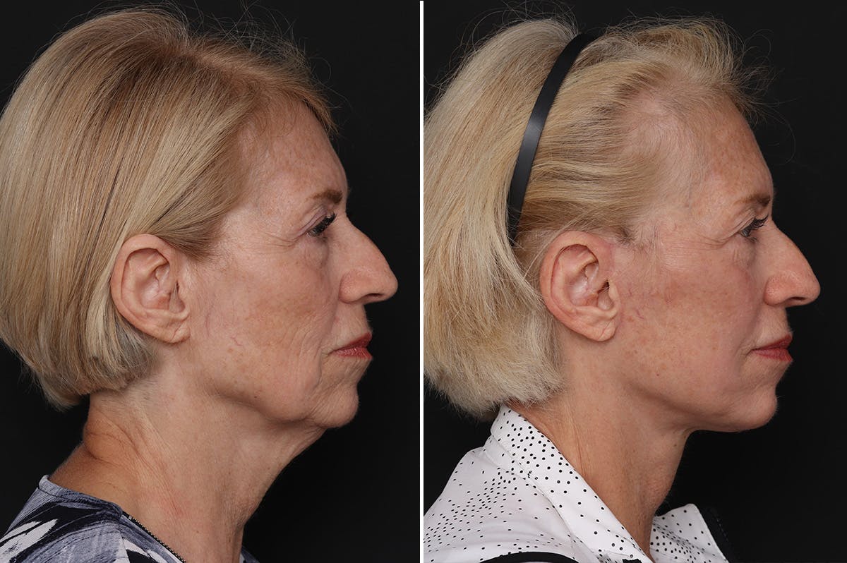 Facelift Before & After Gallery - Patient 228938 - Image 5