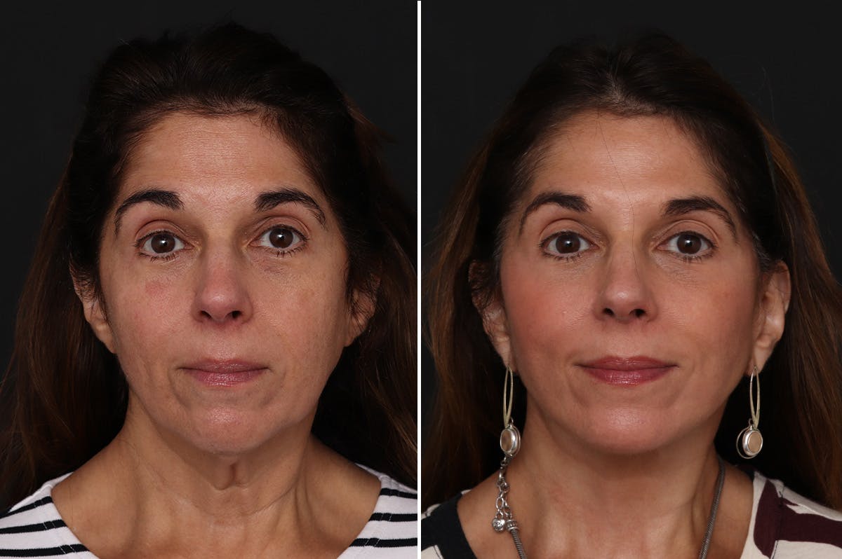 Facelift Before & After Gallery - Patient 255534 - Image 3
