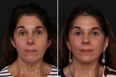 Fat Transfer Before & After Gallery - Patient 389690 - Image 1