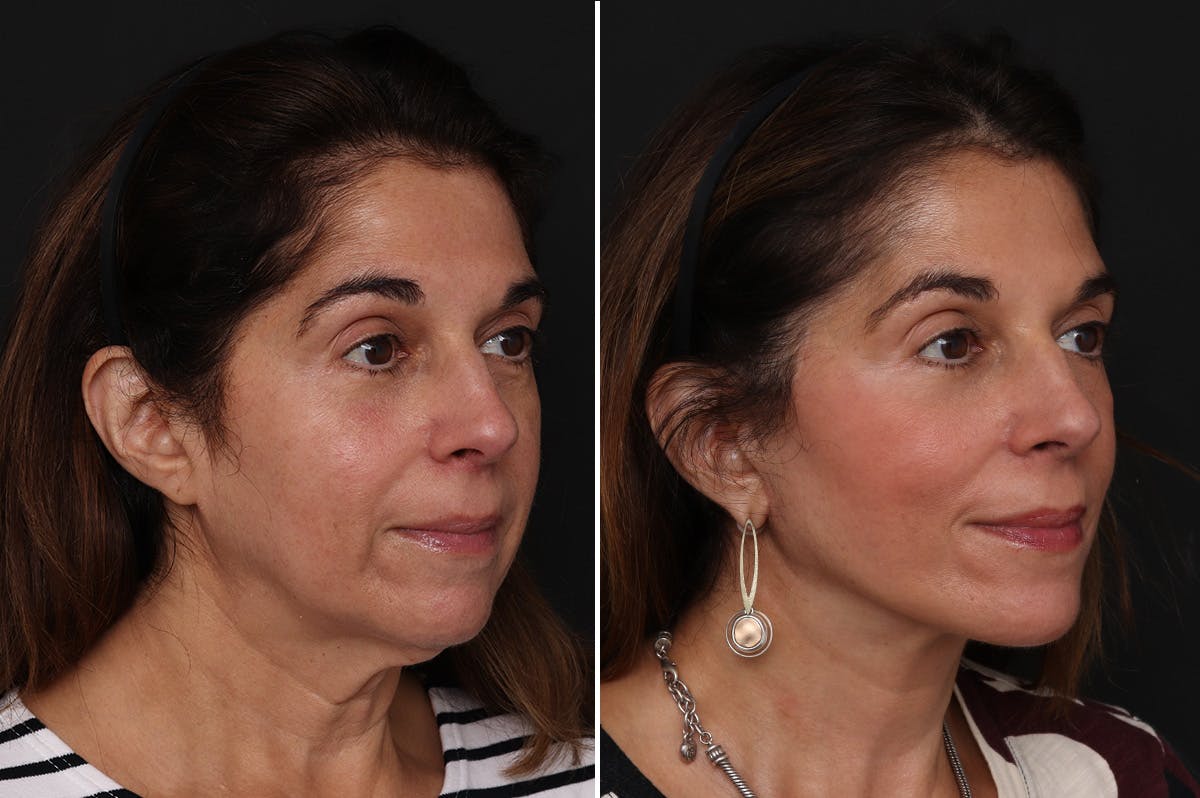 Facelift Before & After Gallery - Patient 255534 - Image 4