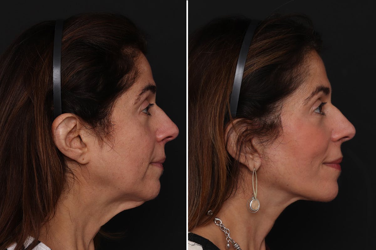 Facelift Before & After Gallery - Patient 255534 - Image 5