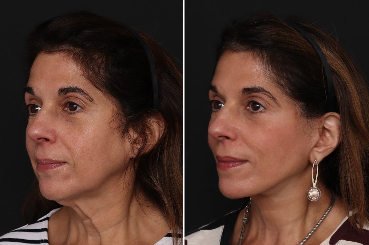 Facelift Before & After Gallery - Patient 255534 - Image 2