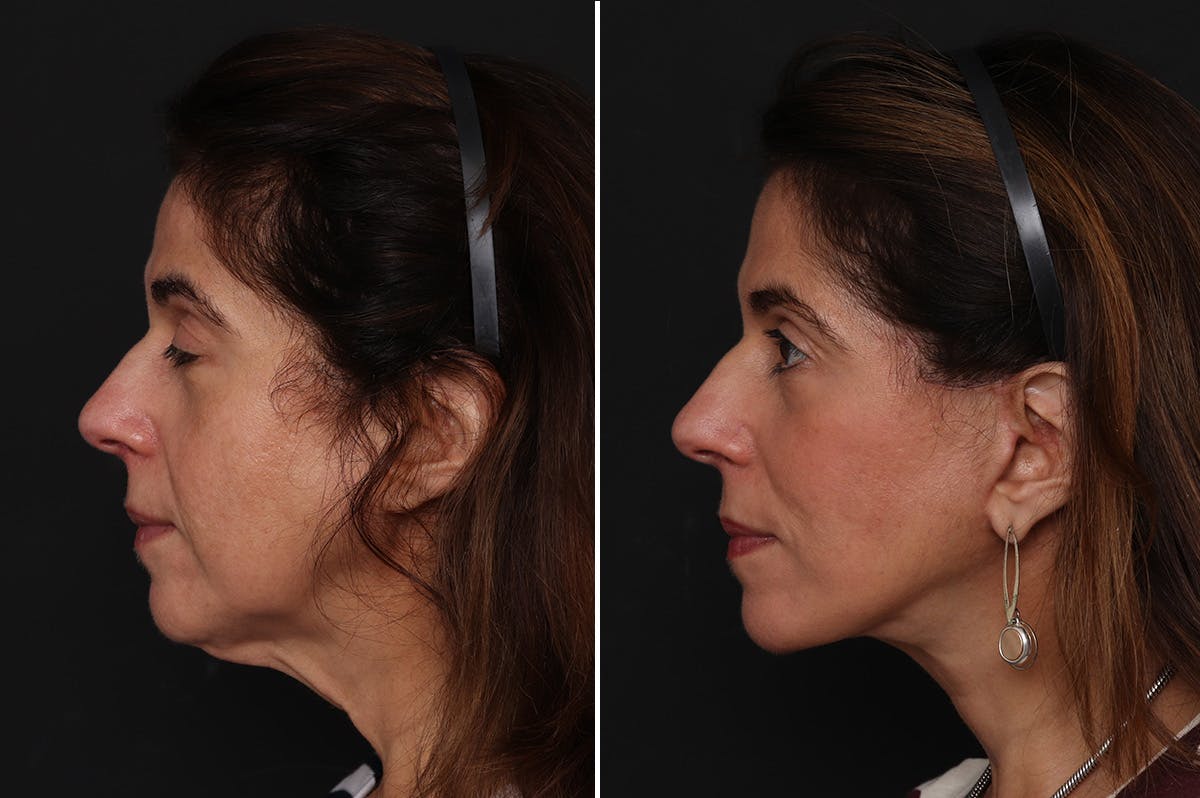 Facelift Before & After Gallery - Patient 255534 - Image 1