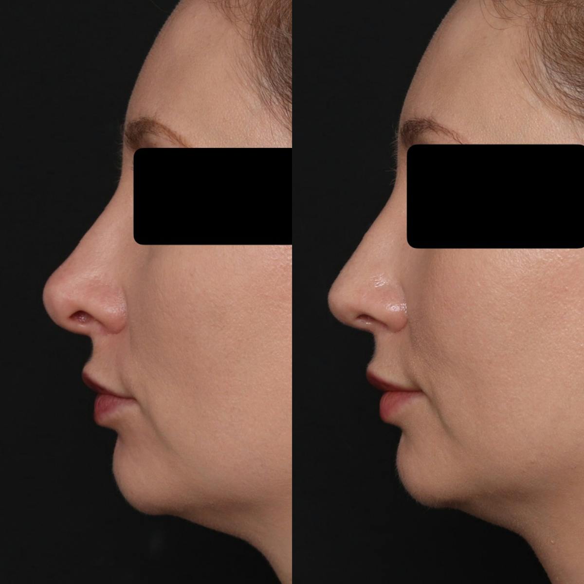 Revision Rhinoplasty Before & After Gallery - Patient 403507 - Image 1
