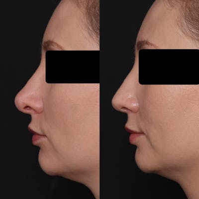 Revision Rhinoplasty Before & After Gallery - Patient 403507 - Image 1