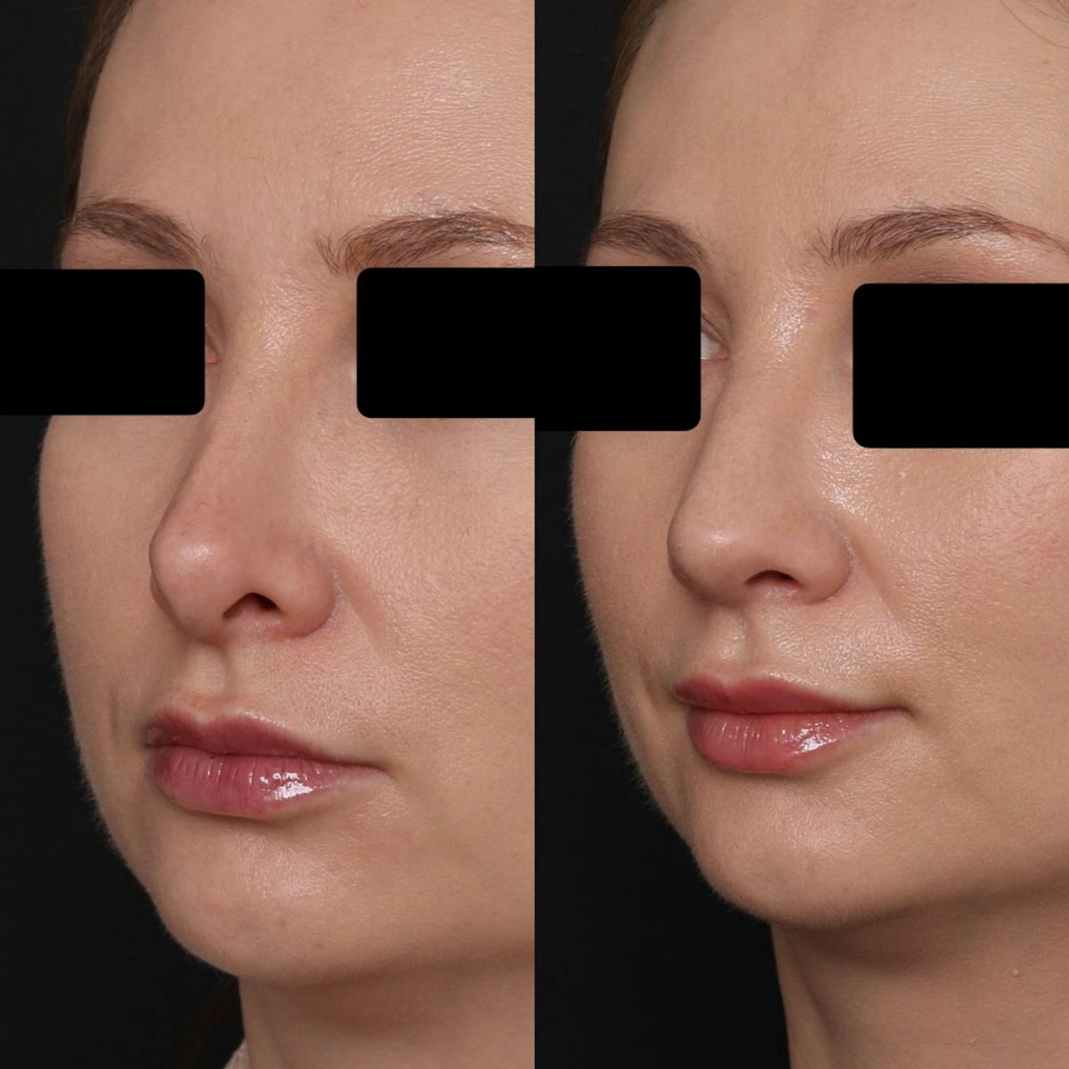Revision Rhinoplasty Before & After Gallery - Patient 403507 - Image 2