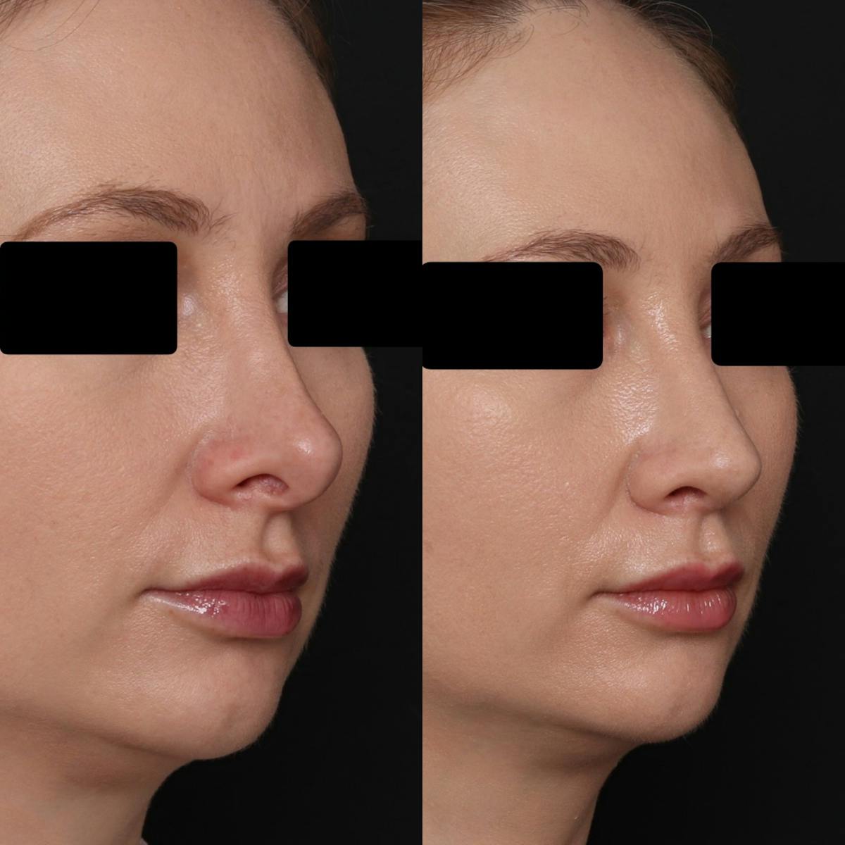 Revision Rhinoplasty Before & After Gallery - Patient 403507 - Image 4