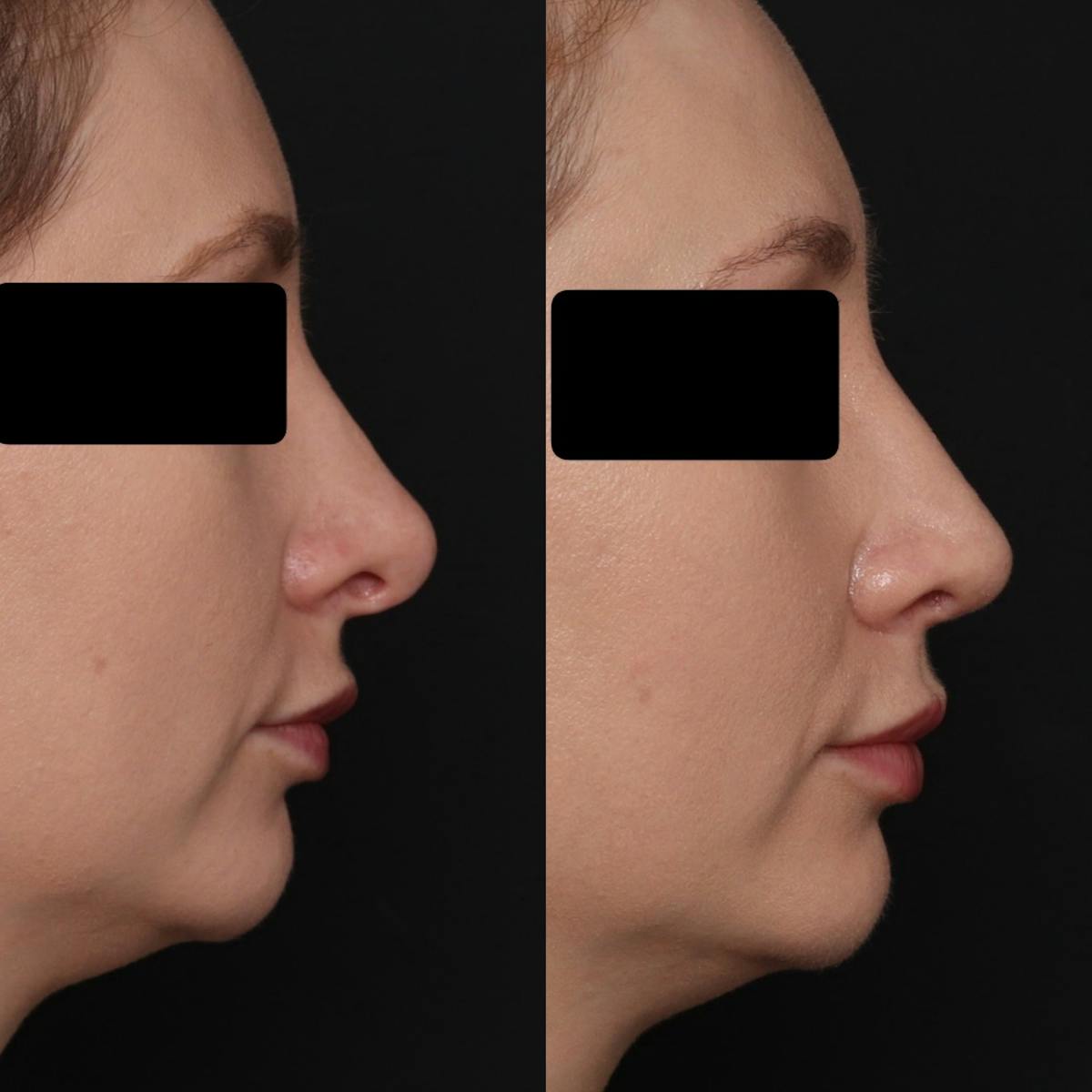 Revision Rhinoplasty Before & After Gallery - Patient 403507 - Image 5