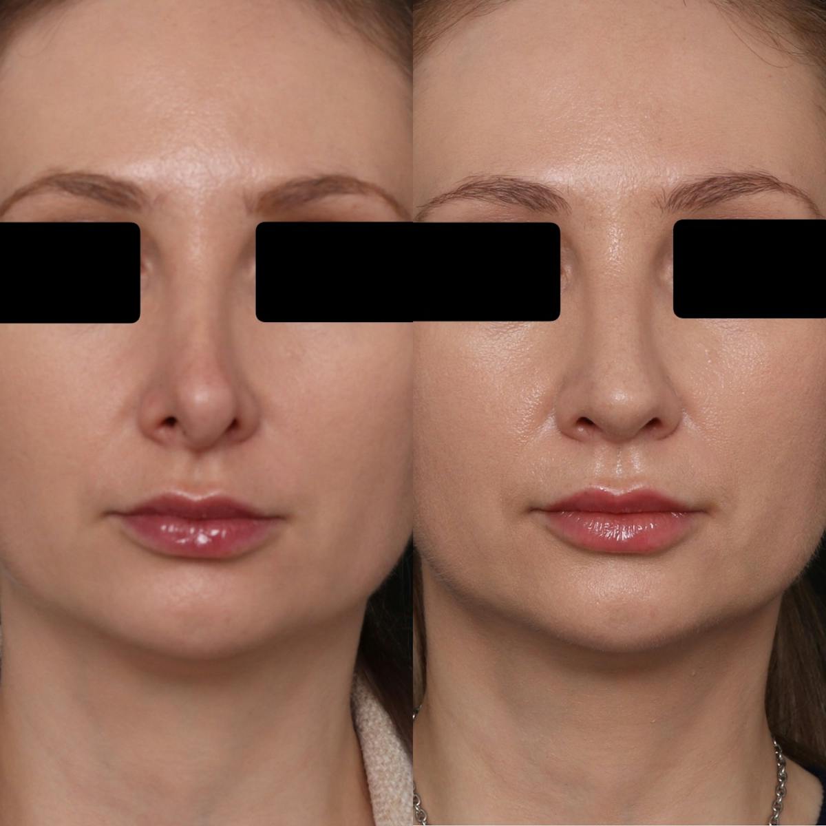 Revision Rhinoplasty Before & After Gallery - Patient 403507 - Image 3