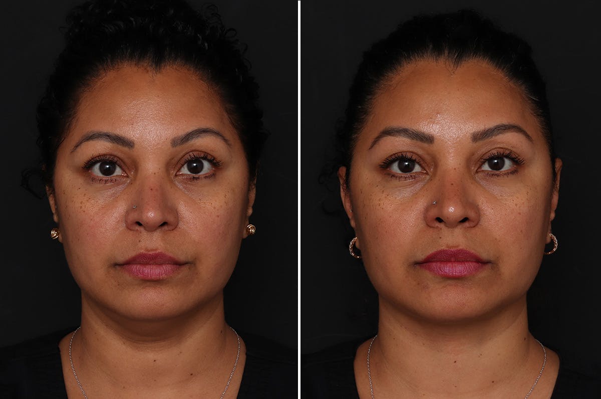 Neck Lift Before & After Gallery - Patient 305643 - Image 3