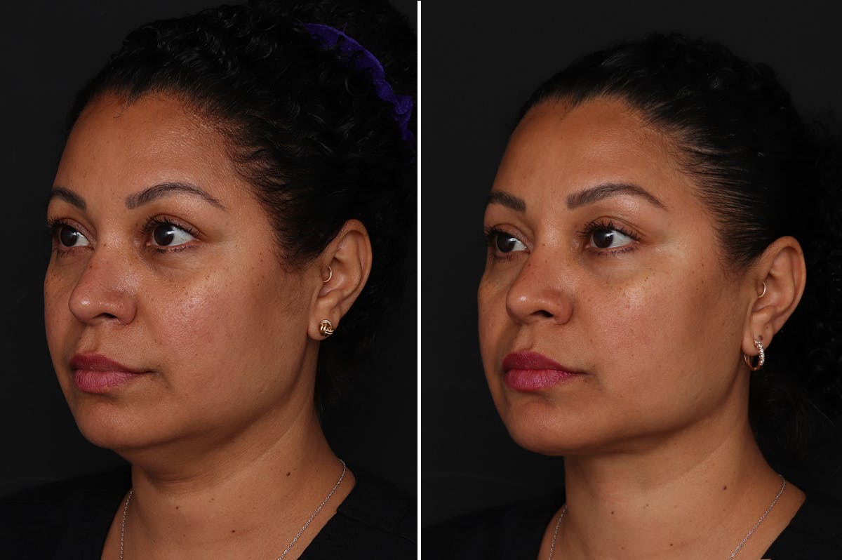 Neck Lift Before & After Gallery - Patient 305643 - Image 2