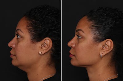 Neck Lift Before & After Gallery - Patient 305643 - Image 1