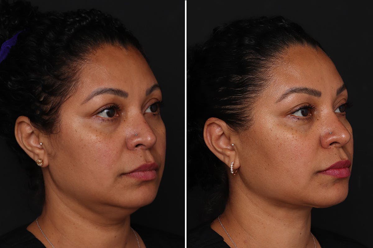 Neck Lift Before & After Gallery - Patient 305643 - Image 4