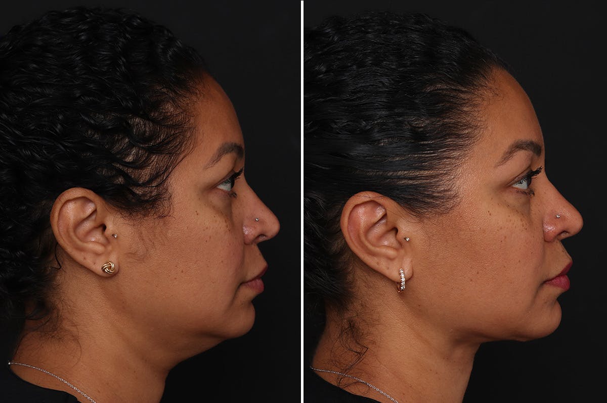 Neck Lift Before & After Gallery - Patient 305643 - Image 5