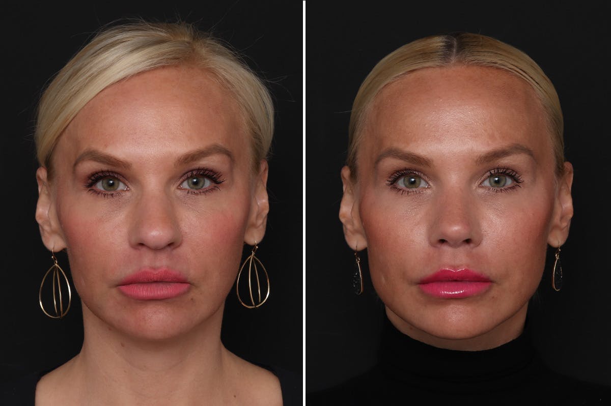 Rhinoplasty Before & After Gallery - Patient 198788 - Image 3