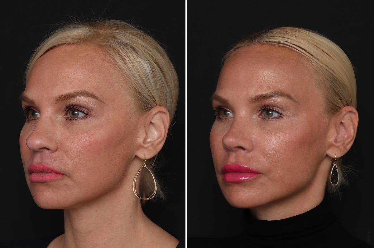 Rhinoplasty Before & After Gallery - Patient 198788 - Image 2