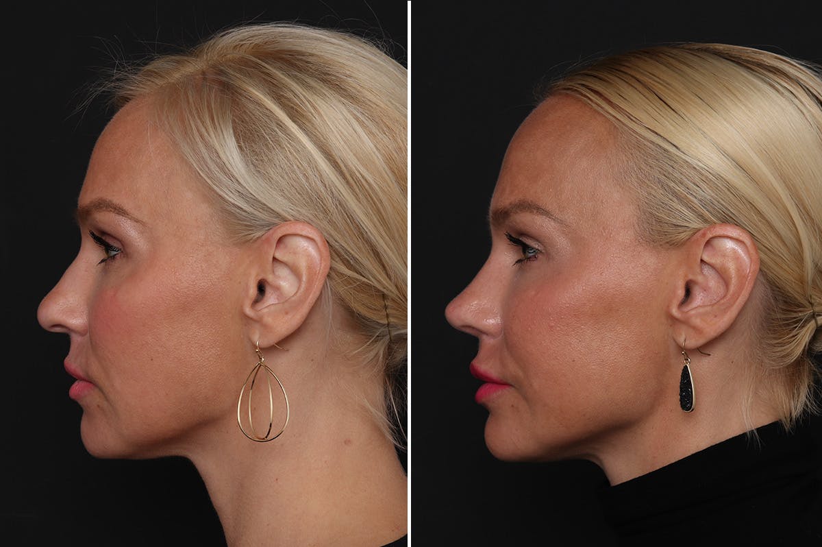 Rhinoplasty Before & After Gallery - Patient 198788 - Image 1