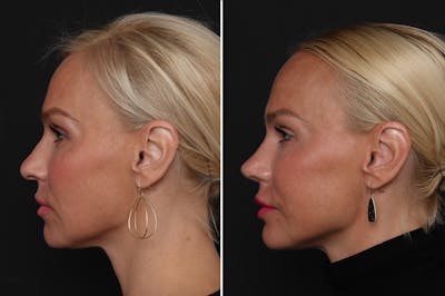 Rhinoplasty Before & After Gallery - Patient 198788 - Image 1