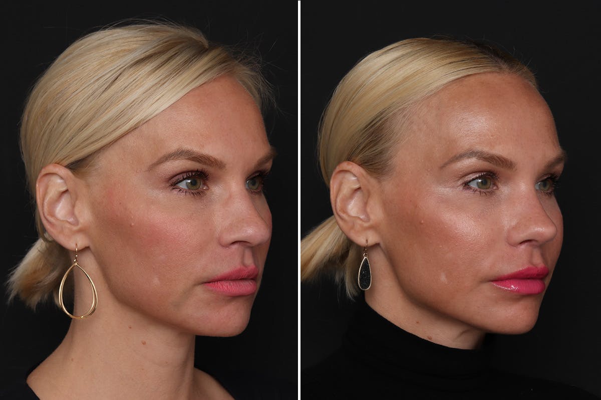 Rhinoplasty Before & After Gallery - Patient 198788 - Image 4