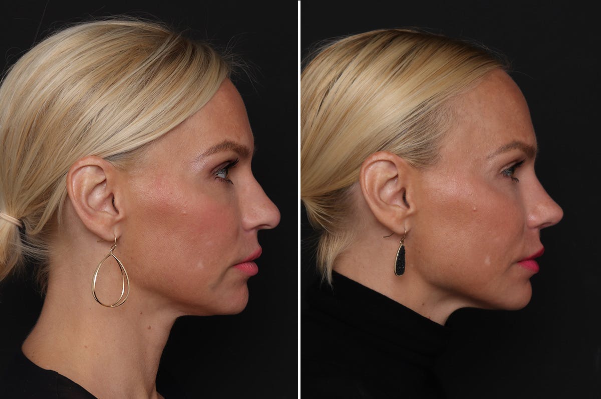 Rhinoplasty Before & After Gallery - Patient 198788 - Image 5