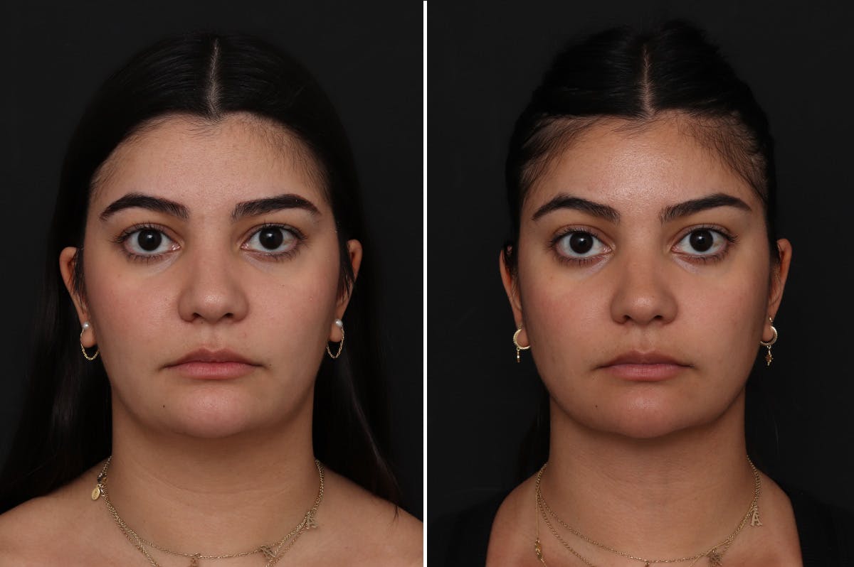 Neck Lift Before & After Gallery - Patient 217773 - Image 3