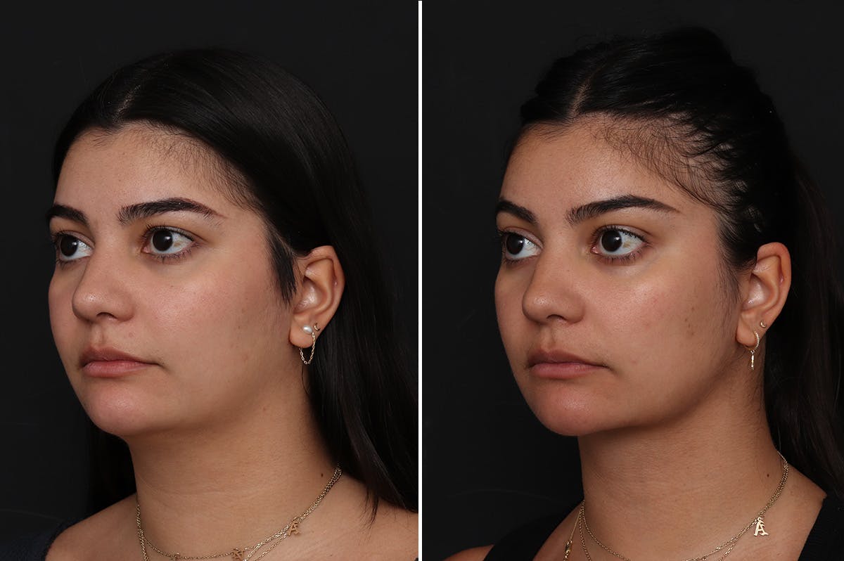 Neck Lift Before & After Gallery - Patient 217773 - Image 2