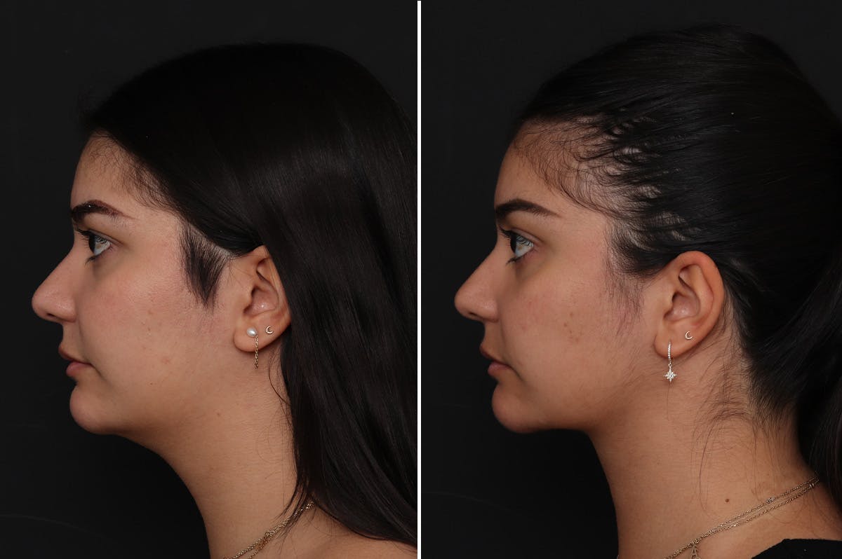Neck Lift Before & After Gallery - Patient 217773 - Image 1