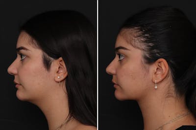 Neck Lift Before & After Gallery - Patient 217773 - Image 1