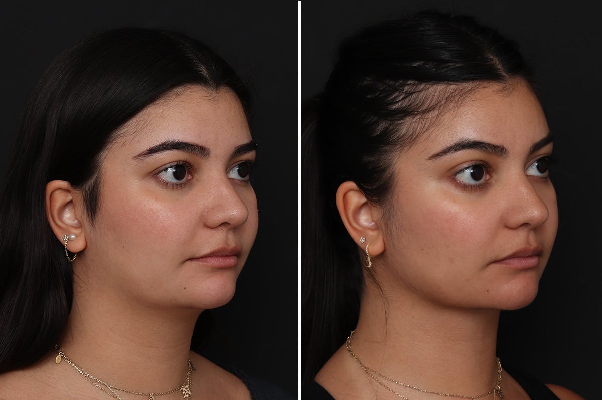 Neck Lift Before & After Gallery - Patient 217773 - Image 4