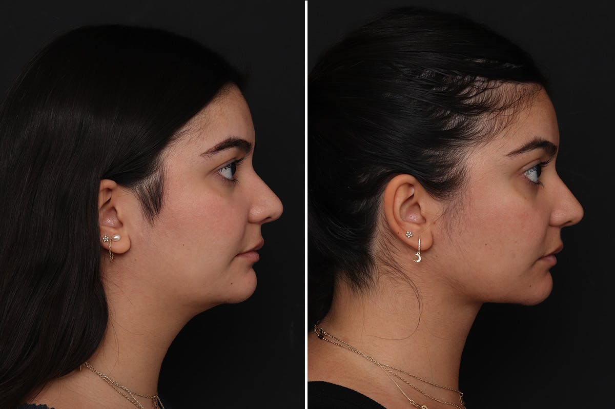 Neck Lift Before & After Gallery - Patient 217773 - Image 5