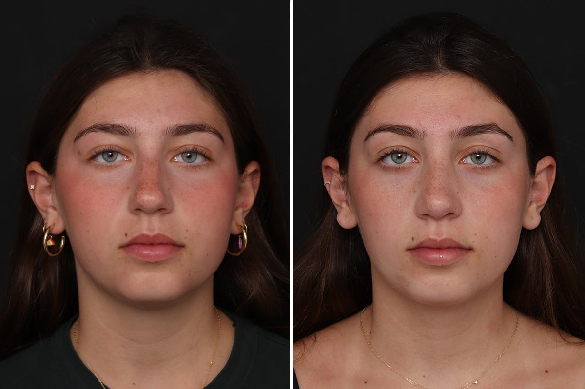 Rhinoplasty Before & After Gallery - Patient 188292 - Image 3