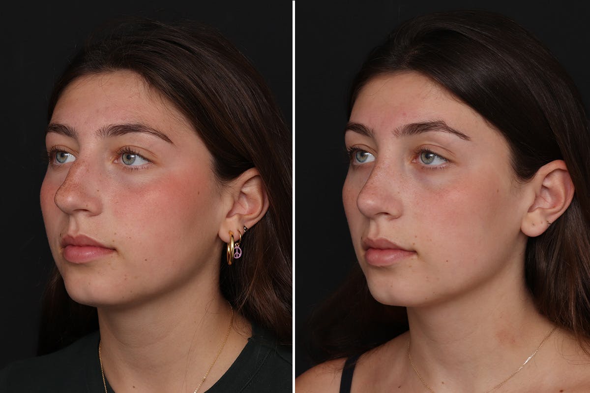 Rhinoplasty Before & After Gallery - Patient 188292 - Image 2