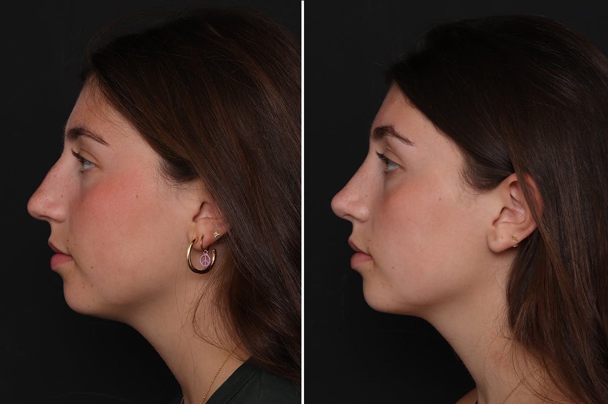 Rhinoplasty Before & After Gallery - Patient 188292 - Image 1