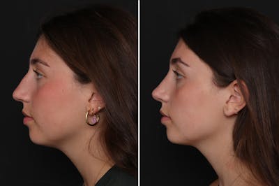 Rhinoplasty Before & After Gallery - Patient 188292 - Image 1