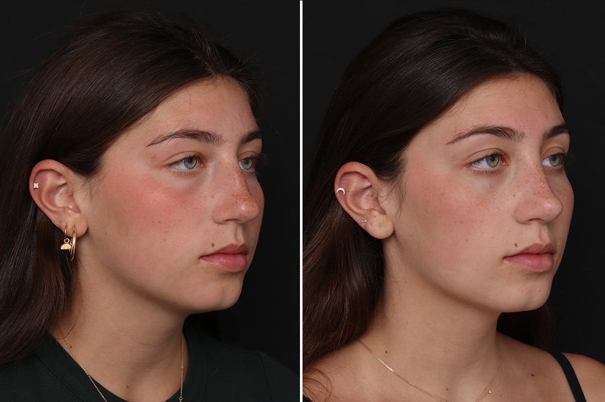 Rhinoplasty Before & After Gallery - Patient 188292 - Image 4
