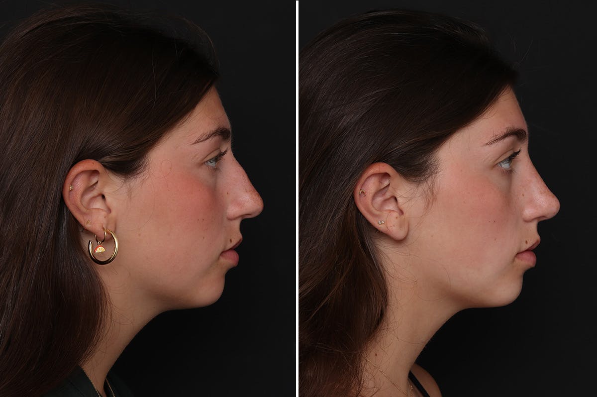Rhinoplasty Before & After Gallery - Patient 188292 - Image 5