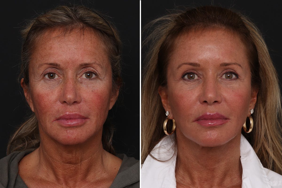 Upper Eyelid Before & After Gallery - Patient 113902 - Image 1