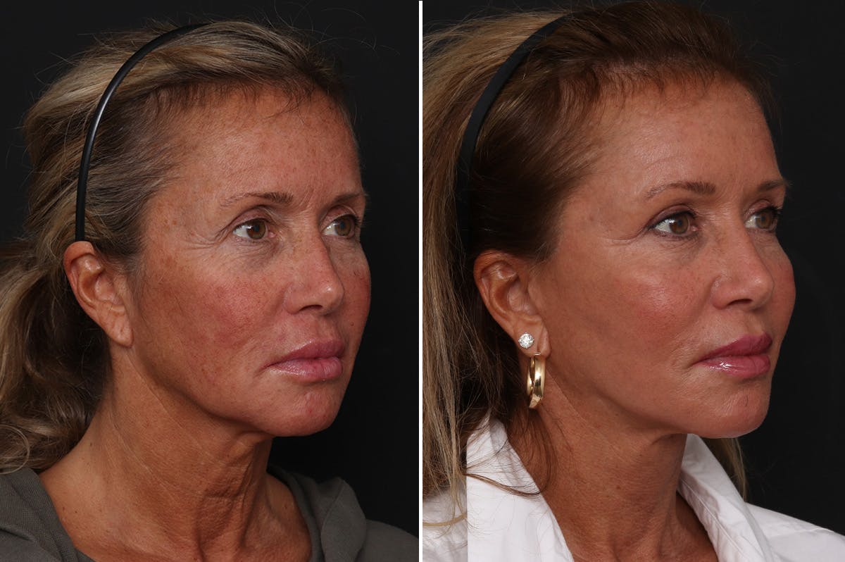 Upper Eyelid Before & After Gallery - Patient 113902 - Image 3