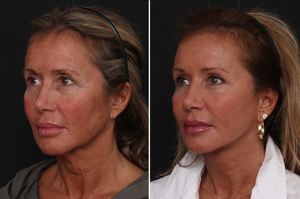 Upper Eyelid Before & After Gallery - Patient 113902 - Image 2