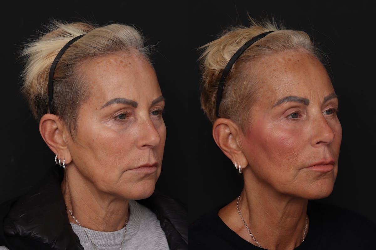 Lower Eyelid Before & After Gallery - Patient 358508 - Image 3