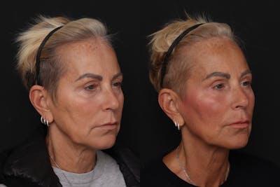 Fat Transfer Before & After Gallery - Patient 128199 - Image 1